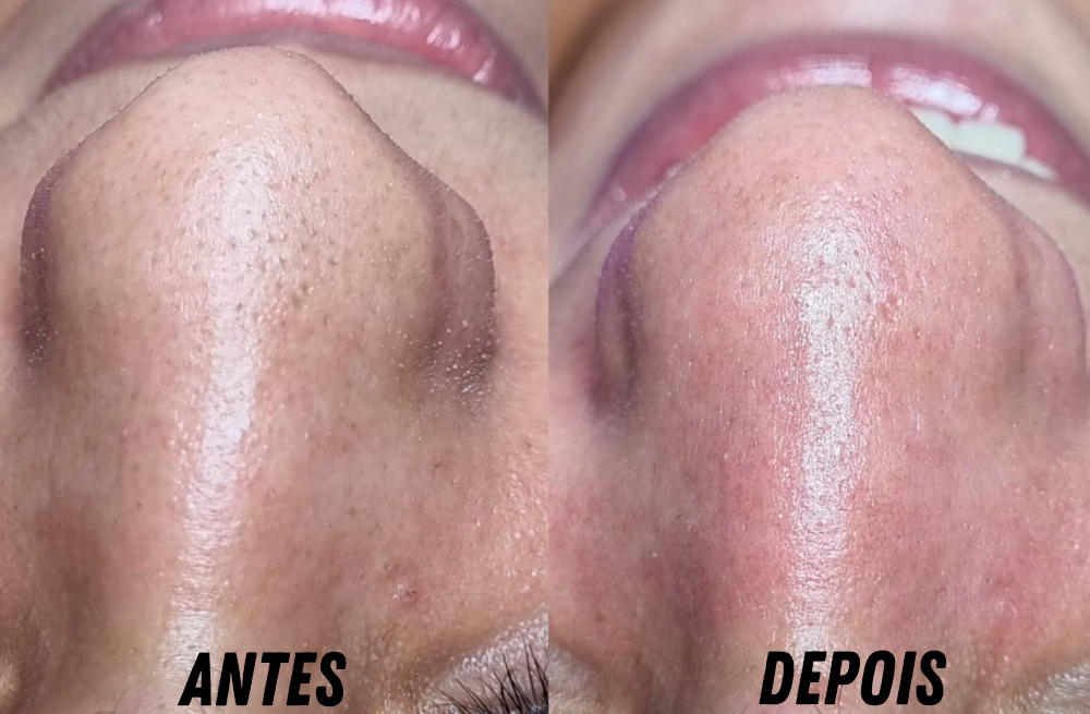 antes e depois kit limpeza de pele beleza10